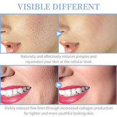 Before and after photos showing skin with reduced acne and fewer fine lines.