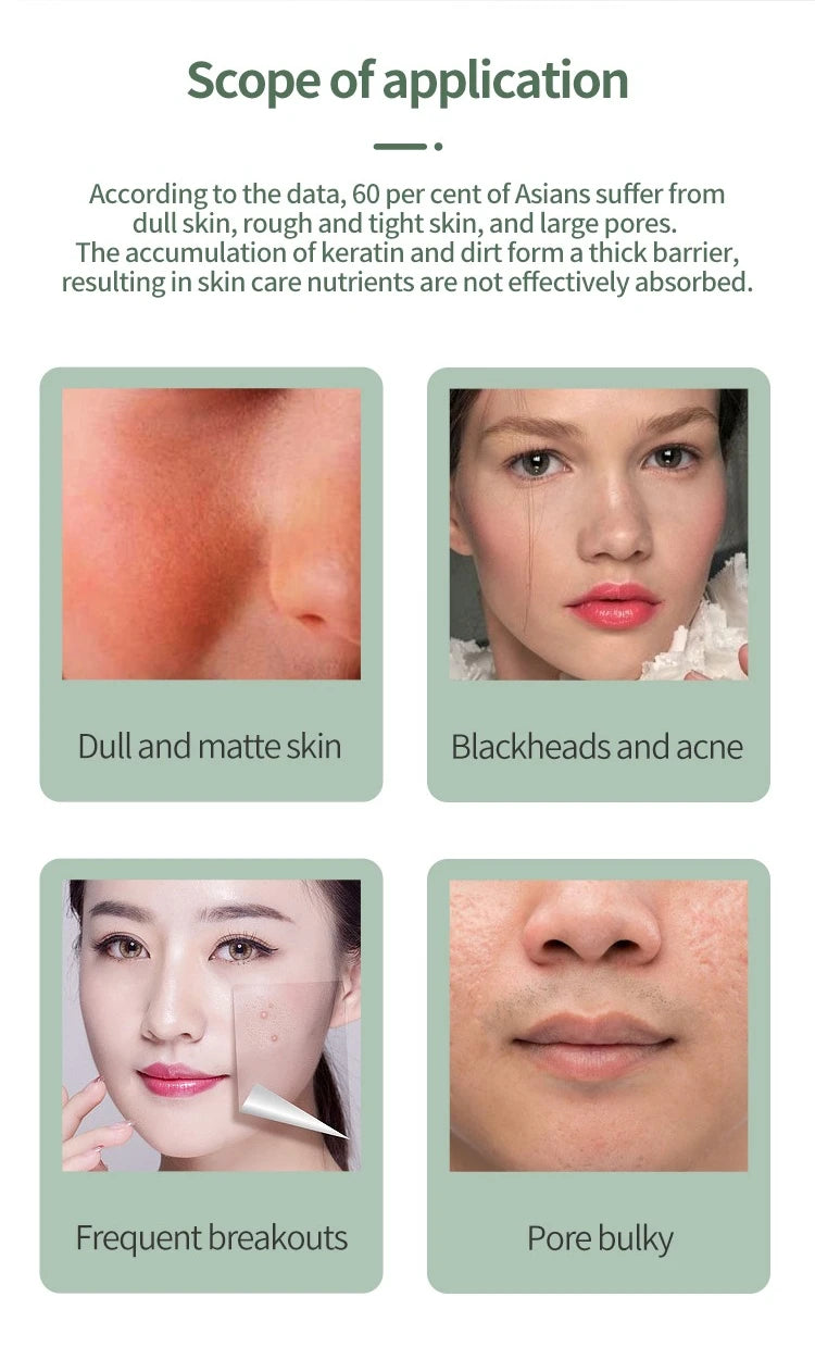 Showlu Smart General LED Acne Spot Pen with a sleek design for targeted blemish treatment.