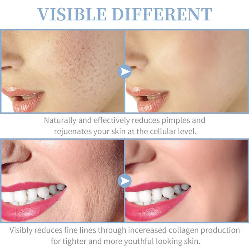 Portable SHOWLU FASHION STORE Miqmi High Frequency Skin Therapy Wand for acne and wrinkle treatment, shown in a sleek black design.