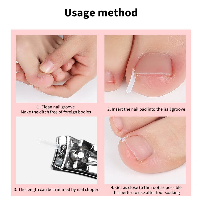 Set of 50 Showlu Fashion Store ingrown toenail correction tools including elastic patch stickers and straightening clips for pedicure treatment.