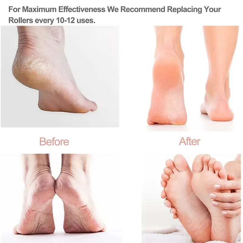 Showlu Smart Rechargeable Electric Foot Callus Remover tool with grinding head for smooth, soft feet and easy at-home pedicure care.