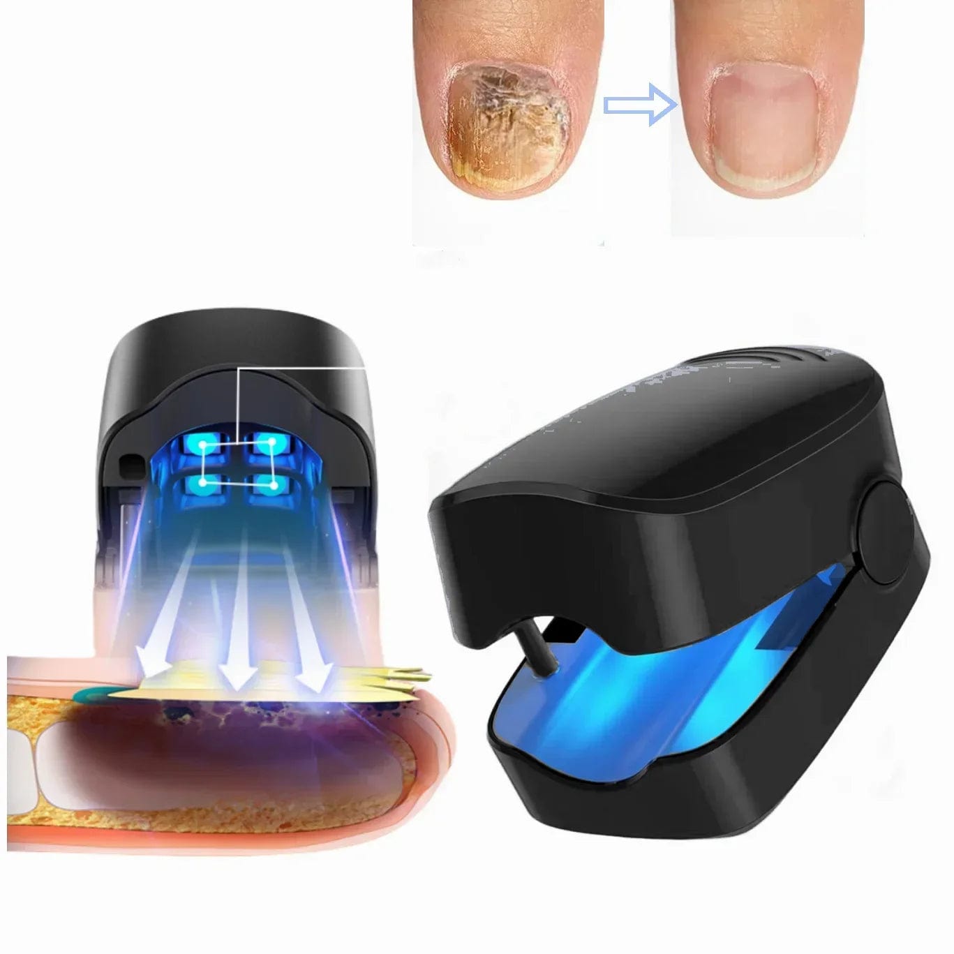 SHOWLU FASHION STORE Nail Fungus Treatment LED Laser Device for Cleaning Onychomycosis USB Charge 905nm Infrared Light 470nm Blue Light Nail Salon