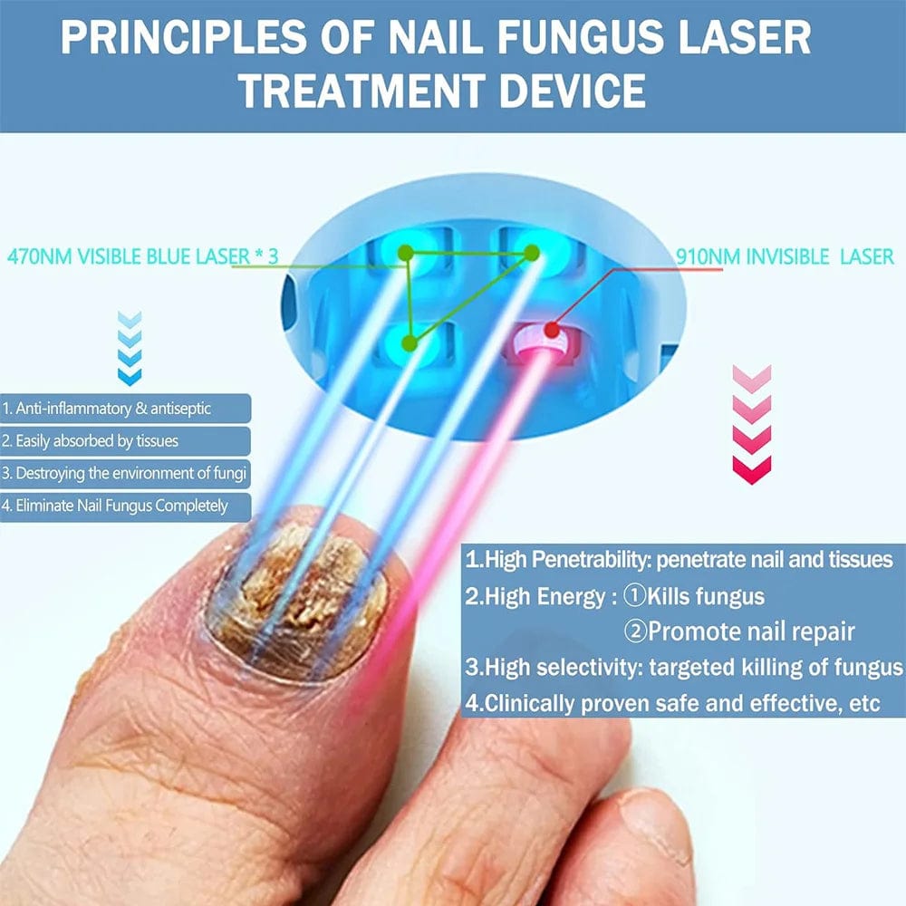 SHOWLU FASHION STORE Nail Fungus Treatment LED Laser Device for Cleaning Onychomycosis USB Charge 905nm Infrared Light 470nm Blue Light Nail Salon