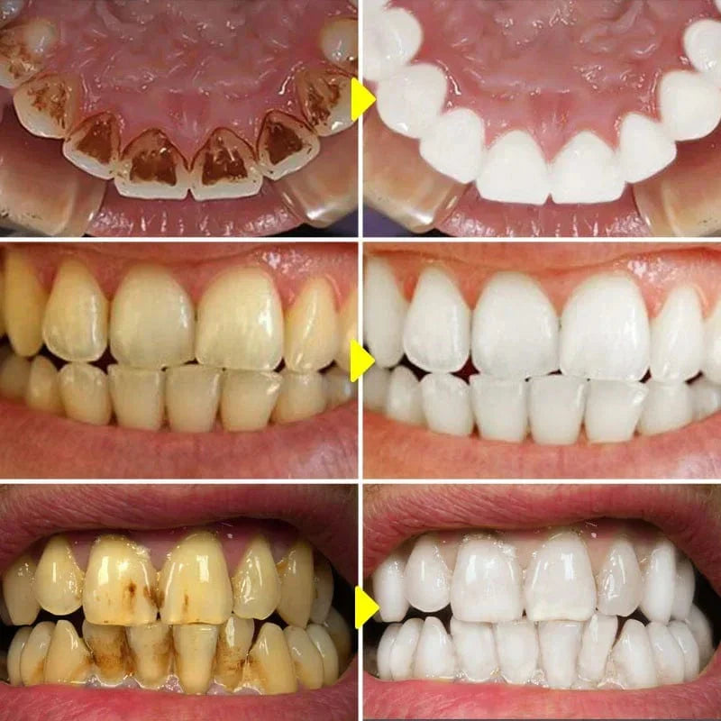 Eelhoe SP-6 Probiotic Whitening Toothpaste in 120g with plaque and stain removal for clean, fresh breath and oral hygiene.